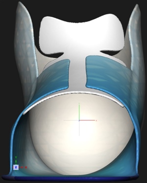 Concept SMO Shell Design with Dorsal Sleeve
