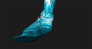 Digital Rendering of a Custom AFO design